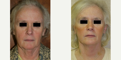 Mini Facelift before and after photo