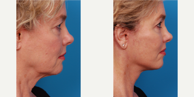 Neck Lift before and after photo