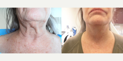 Neck Lift before and after photo