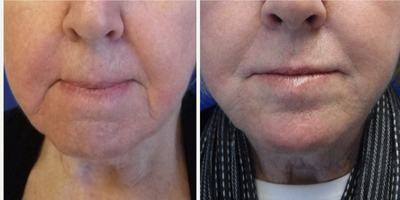 Restylane before and after photo