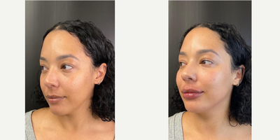 Cheek Fillers before and after photo