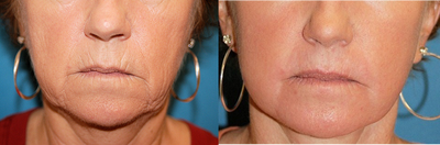 CO2 Laser before and after photo