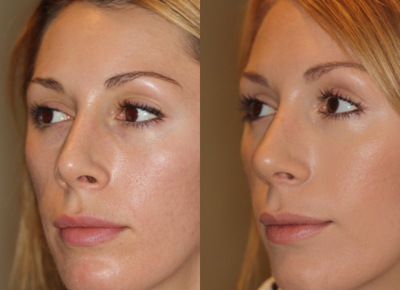 Restylane before and after photo