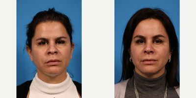 Rhinoplasty before and after photo