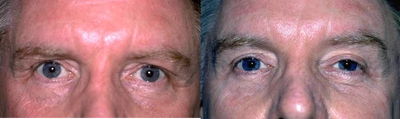 Eyelid Surgery before and after photo