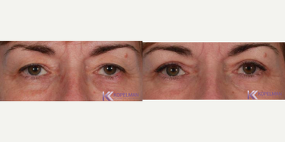 Eyelid Surgery before and after photo