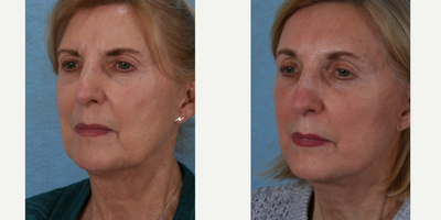 Facelift before and after photo