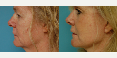 Facelift before and after photo