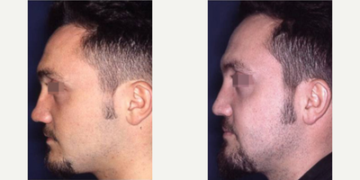 Revision Rhinoplasty before and after photo