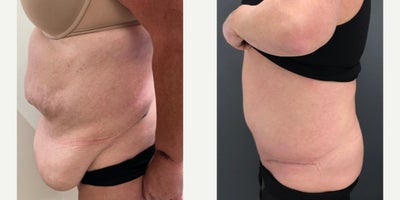 Tummy Tuck before and after photo