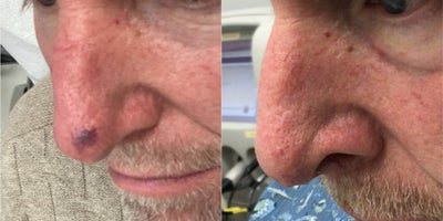 Vbeam before and after photo