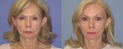 Mini Facelift before and after photo