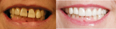 Smile Makeover before and after photo
