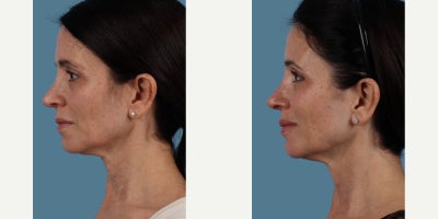 Botox before and after photo