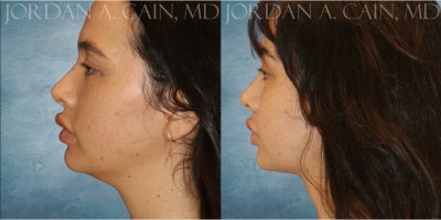 Chin Liposuction before and after photo