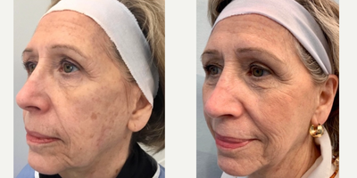 IPL before and after photo