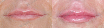 Lip Fillers before and after photo