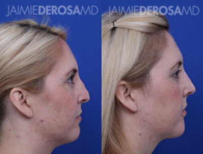 Revision Rhinoplasty before and after photo