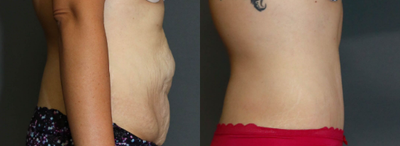 Tummy Tuck before and after photo