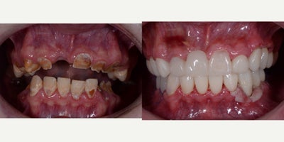 Dental Implants before and after photo