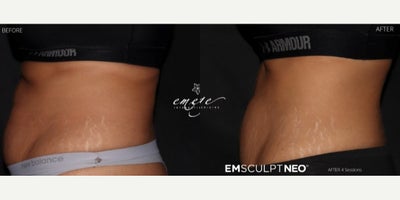 Emsculpt before and after photo