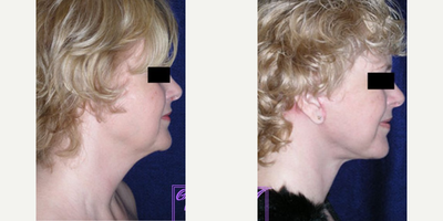 Facelift before and after photo
