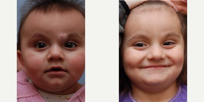 Laser Resurfacing before and after photo