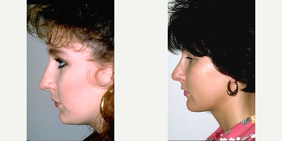 Rhinoplasty before and after photo