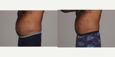 SculpSure before and after photo