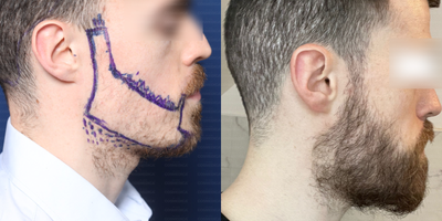 Beard Transplant before and after photo