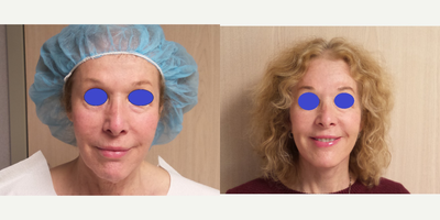 Neck Lift before and after photo