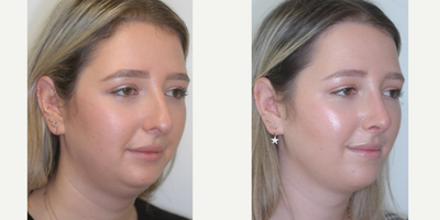 Revision Rhinoplasty before and after photo