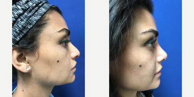 Rhinoplasty before and after photo
