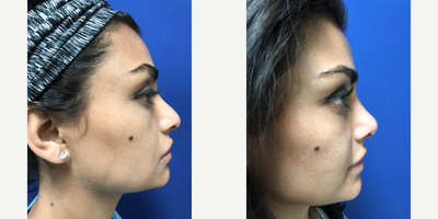 Rhinoplasty before and after photo