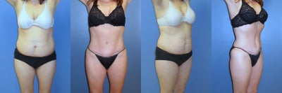 Tummy Tuck before and after photo