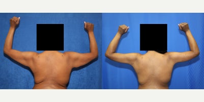 Arm Lift before and after photo