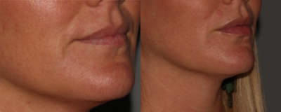 Lip Fillers before and after photo