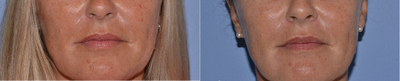 Microdermabrasion before and after photo