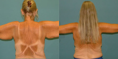 Arm Lift before and after photo