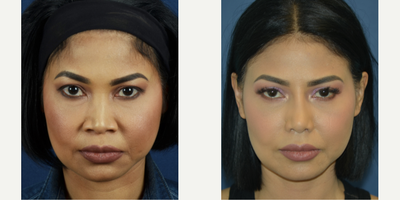 Asian Rhinoplasty before and after photo