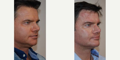 Chin Implant before and after photo