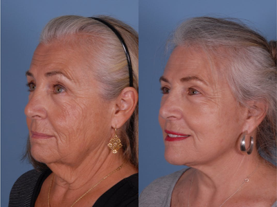 Facelift before and after photo