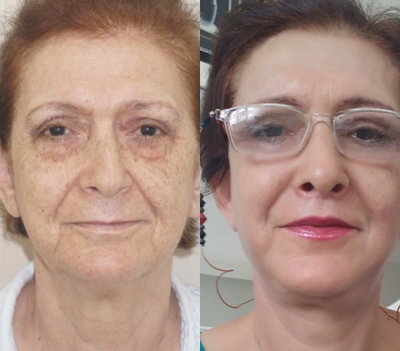 Facelift before and after photo