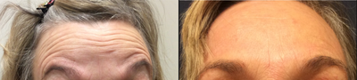 Xeomin before and after photo