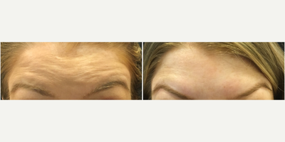 Botox before and after photo