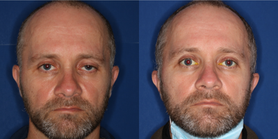 Eyelid Surgery before and after photo