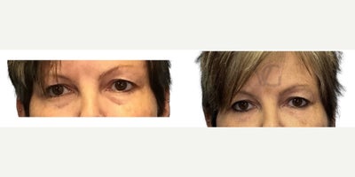 Eyelid Surgery before and after photo