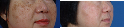IPL before and after photo