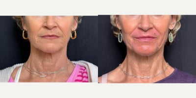 Laser Resurfacing before and after photo