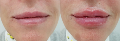 Lip Fillers before and after photo